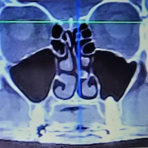 What Are the Paranasal Sinuses?