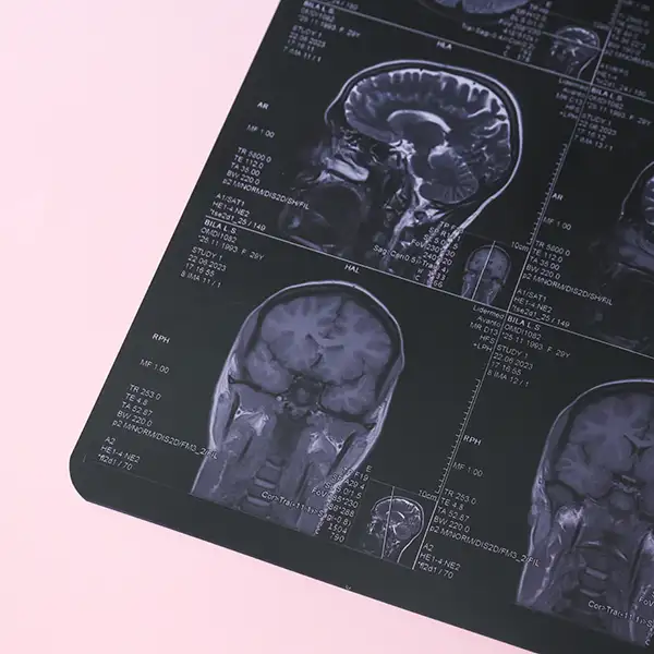 Common Types Of Skull Base Tumours