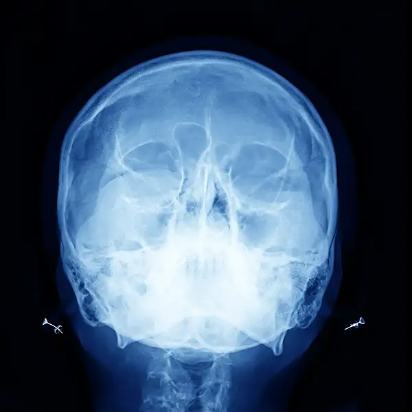 How We Diagnose Skull Base Tumours