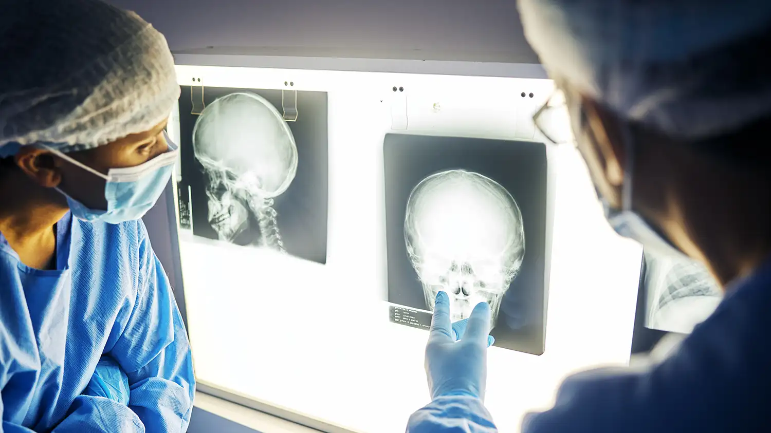 Skull Base Tumour