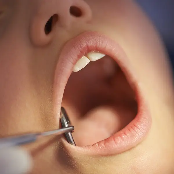 Intracapsular Tonsillectomy Procedure