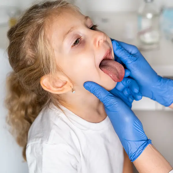 What Is Intracapsular Tonsillectomy